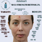 Ammuri retinol 5 serum before and after results showcasing improved skin texture and reduced blemishes