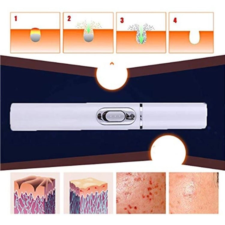 K - SKIN KD - 7910 Acne Laser Pen Portable Wrinkle Removal Machine Durable Soft Scar Remover Device Blue Light Therapy Pen - British D'sire