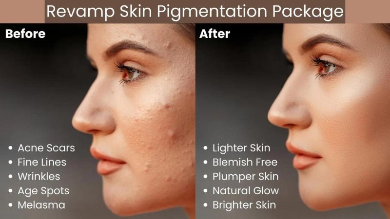 Revamp Skin Pigmentation Package 2 Skincare Gift Set - British D'sire