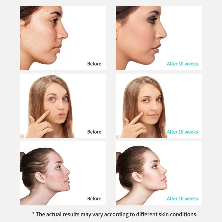 Xpreen Rechargeable Pore Cleanser Home Facial Beauty Device with LED Screen & 4 Probes - British D'sire