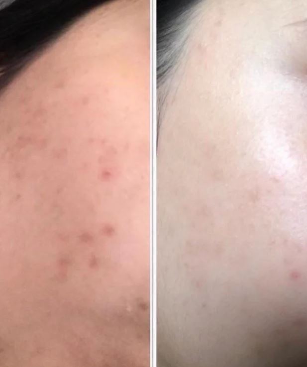 Tanash Beauty Spot Gel Acne Treatment - Face Care - British D'sire