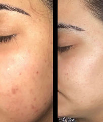 Tanash Beauty Spot Gel Acne Treatment - Face Care - British D'sire